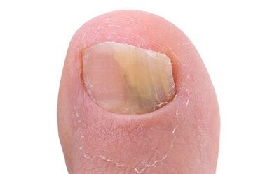 Symptoms of the presence of fungus on the thumb of the leg
