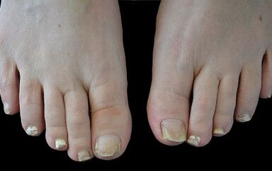 how to get rid of the fungus on your fingers