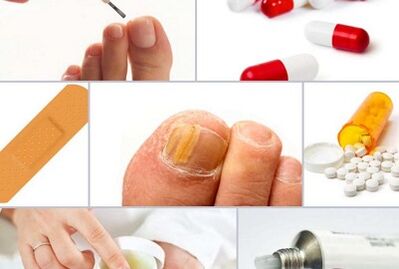 how to treat fungus on the nails