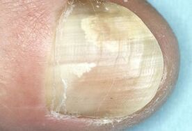 damage to the nail plate due to a fungal infection