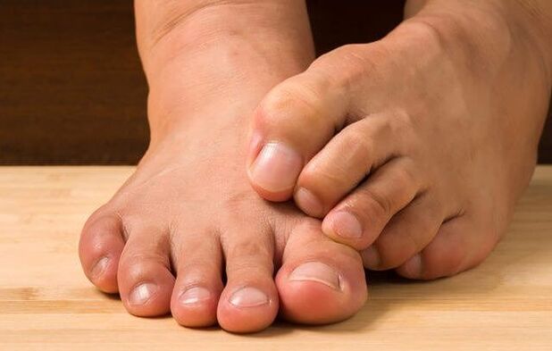 foot fungus and remedies for its treatment