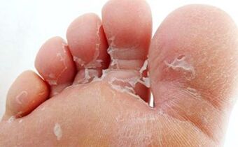 how to treat foot fungus